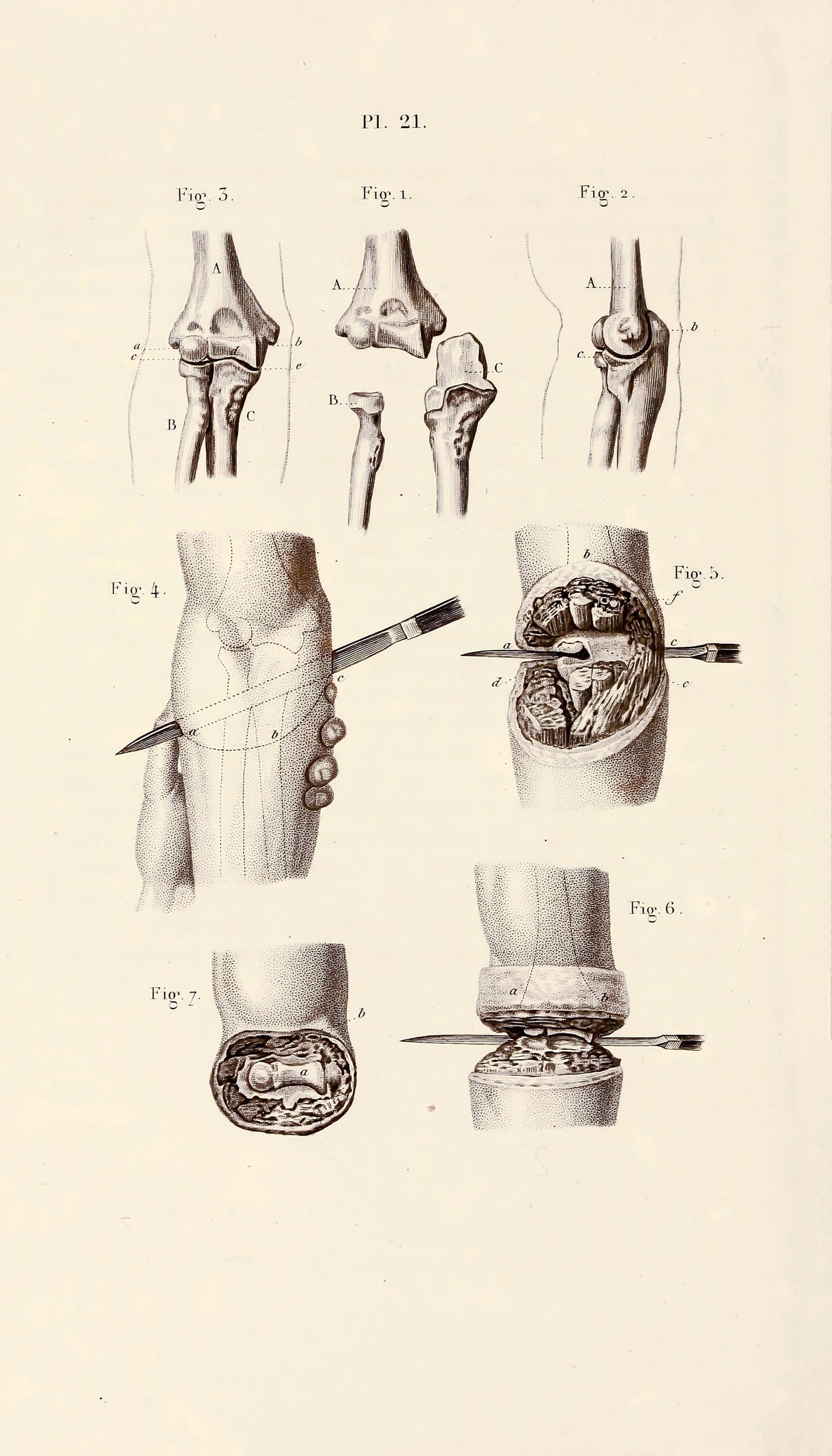 Illustrated Manual of Operative Surgery and Surgical Anatomy Set 1 [55 Images]